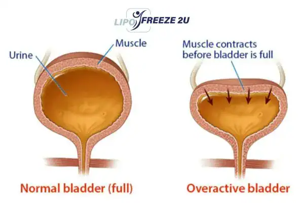 diagram of overactive bladder treatment Greenwich