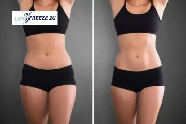 How Can LIPO FREEZE 2U Support Your Post-Pregnancy Body Recovery Greenwich?