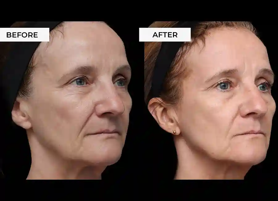 How Many RF Microneedling Sessions Will You Need to See a Difference Greenwich?