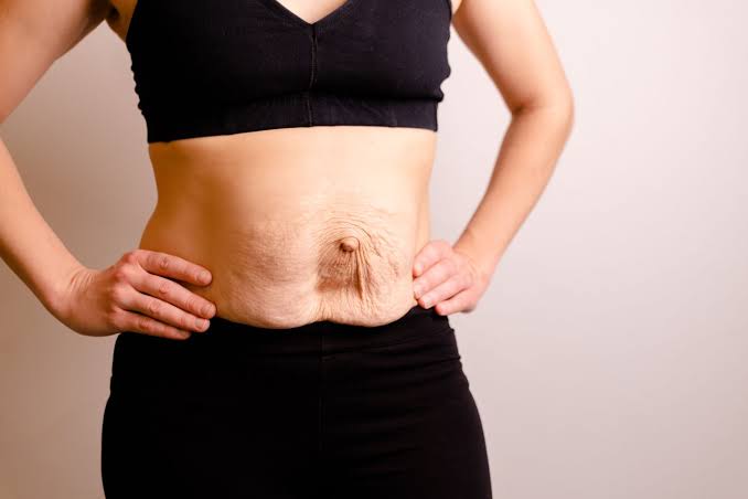 Is Surgery Really the Only Way to Repair Diastasis Recti Greenwich?