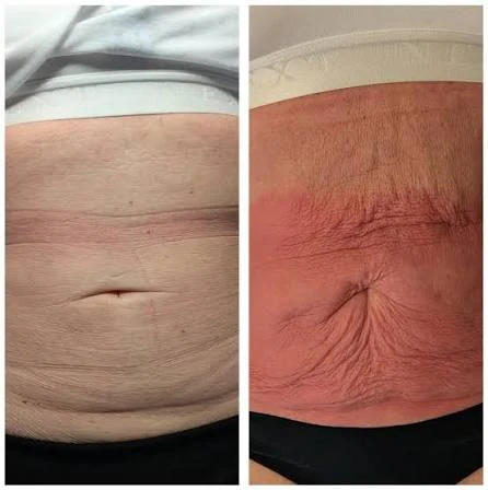 How Does RF Microneedling Improve Crepey, Thin and Uneven Skin Texture Greenwich?