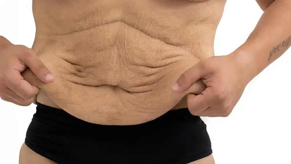 RF Microneedling for Loose Skin: How Can It Help Tighten and Reshape the Skin Greenwich?
